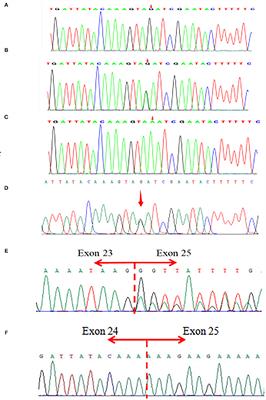 Identification of a Hemizygous Novel Splicing Variant in ATRX Gene: A Case Report and Literature Review